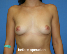 plastic-surgery-breast-augmentation